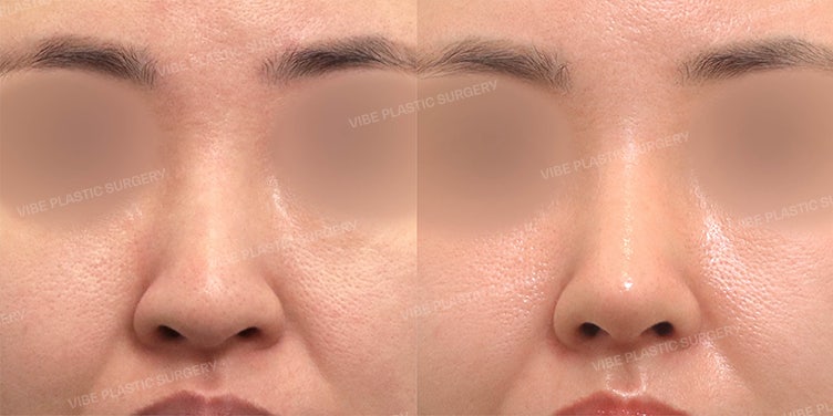 Memperbaiki Bentuk Hidung yang Kurang Maksimal dengan Filler & Hiko / Rhinoplasty Tanpa Implan & Fungsional oleh dr. Yoo Young-moon, VIBE Plastic Surgery