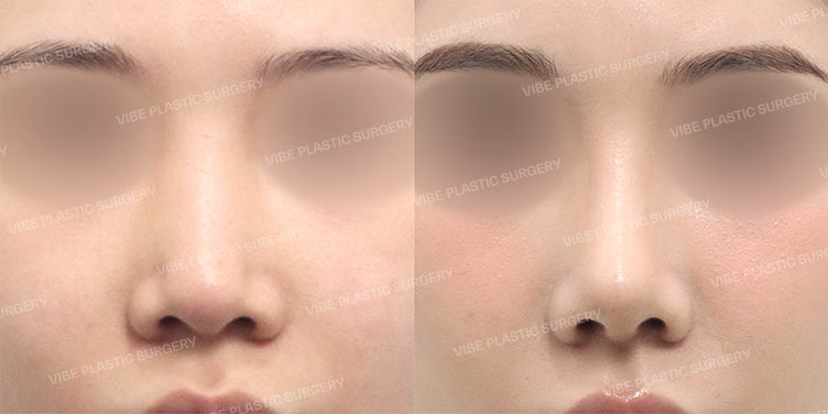 Revision Rhinoplasty with Autologous Rib Cartilage for a Bulbous and Long Nose by Dr. Young-moon Yoo of VIBE Plastic Surgery