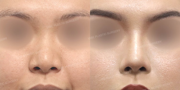 Spesialis Rhinoplasty untuk Hidung Lebar dan Pendek | Perubahan Alami dengan Tulang Rawan Iga oleh dr. Yoo Young-moon, VIBE Plastic Surgery
