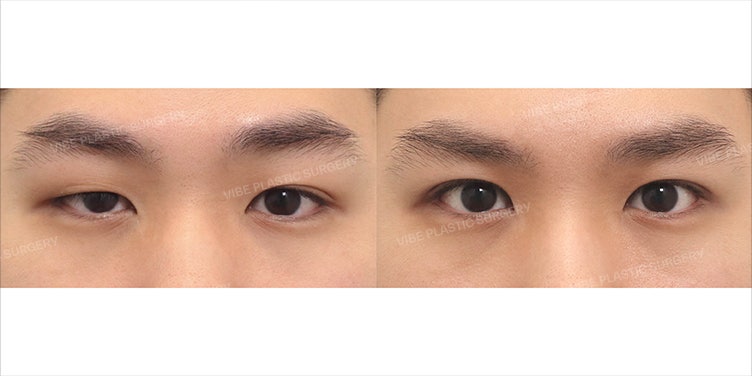 ตาไม่เท่ากันอย่างรุนแรงจากภาวะกล้ามเนื้อตาอ่อนแรงแต่กำเนิด ทำไมต้องแก้ไขด้วยการปรับกล้ามเนื้อตาแบบกรีด โดย นพ. ยูยองมุน ผู้อำนวยการ VIBE Plastic Surgery