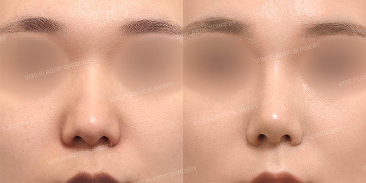 Koreksi Hidung Punuk, Hidung Lebar, dan Ujung Hidung Turun Sekaligus! Rhinoplasty di Vibe Plastic Surgery Gangnam/Sinnonhyeon