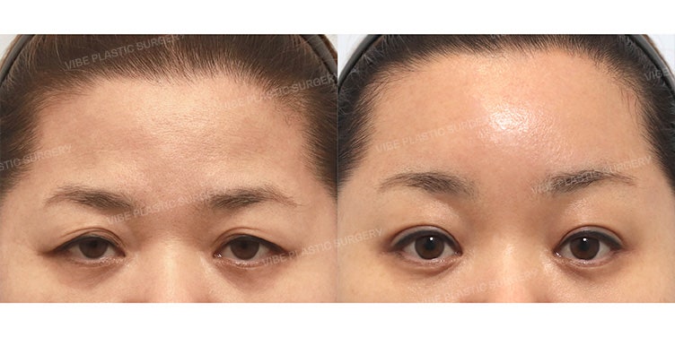 Middle-Aged Sagging Eyes: Don't Just Think About Upper Blepharoplasty! - Dr. Young-moon Yoo, VIBE Plastic Surgery