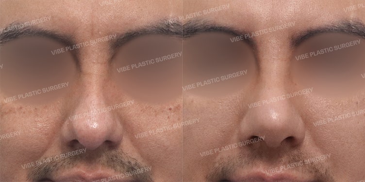 Functional & Implant-Free Rhinoplasty for International Patients - VIBE Plastic Surgery