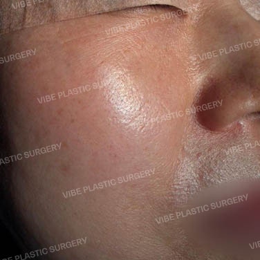 شد منطقة تحت العين والخدين (Cheek-fting)؟!! إعادة توزيع دهون تحت العين + شد منتصف الوجه في آن واحد؟! الدكتور يو يونغ-مون، عيادة فايب للتجميل بمحطة شين نونهيون