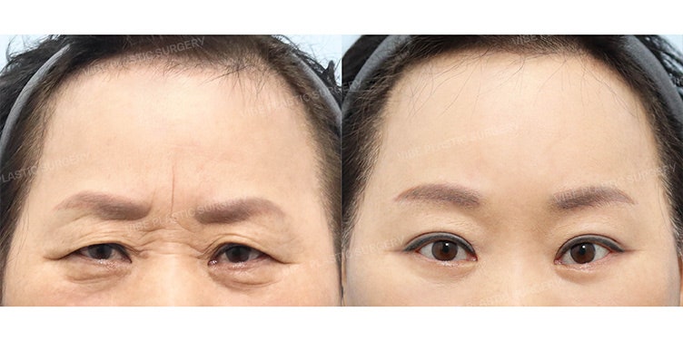 ศัลยกรรมตารอบทิศทางสำหรับวัย 60+ เพื่อดวงตาดูอ่อนเยาว์อย่างเป็นธรรมชาติ โดย นพ. ยู ยองมุน ผู้อำนวยการ VIBE Plastic Surgery สถานีชินนนฮยอน