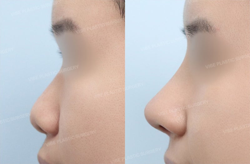 [جراحة تجميل الأنف للرجال] مراجعة حقيقية لرجل في العشرينات من عمره قام بحل مشكلة انخفاض جسر الأنف والأنف المنتفخ، وحتى م