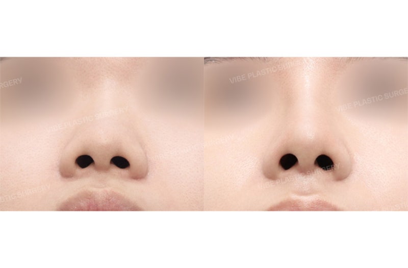 [جراحة تجميل الأنف للرجال] مراجعة حقيقية لرجل في العشرينات من عمره قام بحل مشكلة انخفاض جسر الأنف والأنف المنتفخ، وحتى م