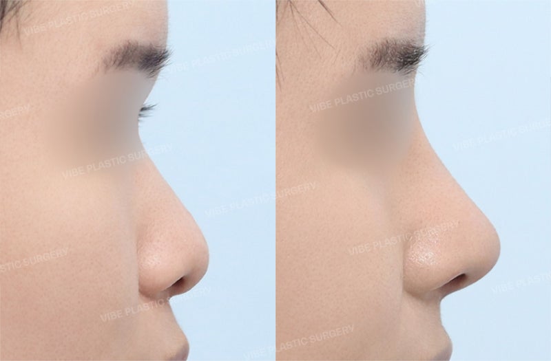 [جراحة تجميل الأنف للرجال] مراجعة حقيقية لرجل في العشرينات من عمره قام بحل مشكلة انخفاض جسر الأنف والأنف المنتفخ، وحتى م