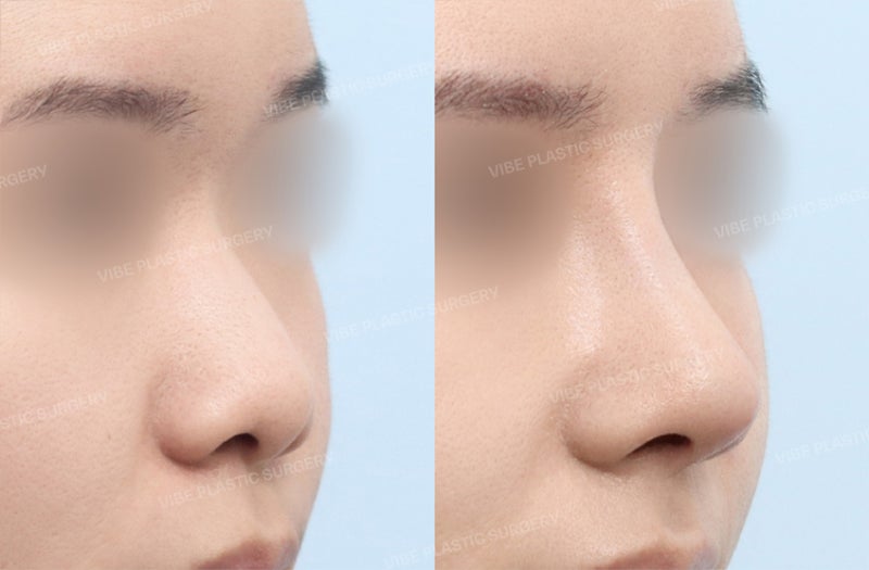 [جراحة تجميل الأنف للرجال] مراجعة حقيقية لرجل في العشرينات من عمره قام بحل مشكلة انخفاض جسر الأنف والأنف المنتفخ، وحتى م