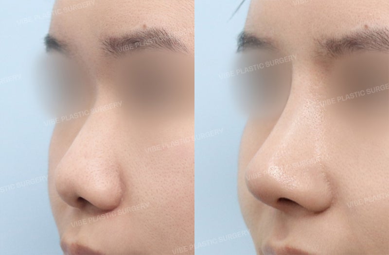 [جراحة تجميل الأنف للرجال] مراجعة حقيقية لرجل في العشرينات من عمره قام بحل مشكلة انخفاض جسر الأنف والأنف المنتفخ، وحتى م
