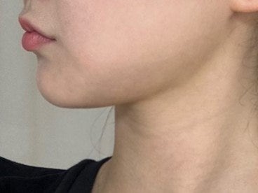 얼굴은 마른데 이중턱만 고민이라면? 리포사운드 이중턱 지방흡입 + 심부볼 지방제거 후기 by 신논현역 바이브 성형외과 유영문 원장 사진 7