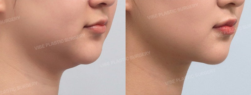 얼굴은 마른데 이중턱만 고민이라면? 리포사운드 이중턱 지방흡입 + 심부볼 지방제거 후기 by 신논현역 바이브 성형외과 유영문 원장 사진 4