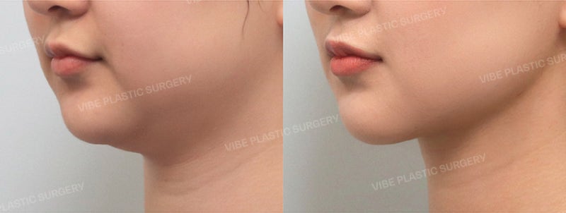 얼굴은 마른데 이중턱만 고민이라면? 리포사운드 이중턱 지방흡입 + 심부볼 지방제거 후기 by 신논현역 바이브 성형외과 유영문 원장 사진 2