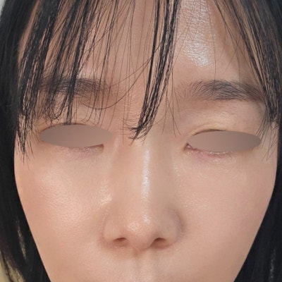 눈밑지방 + 다크서클 + 팔자주름이 함께 고민이라면? 바이브 성형외과 시그니처 '눈밑 칙프팅'으로 자연스럽게 젊어지는 방법 사진 7