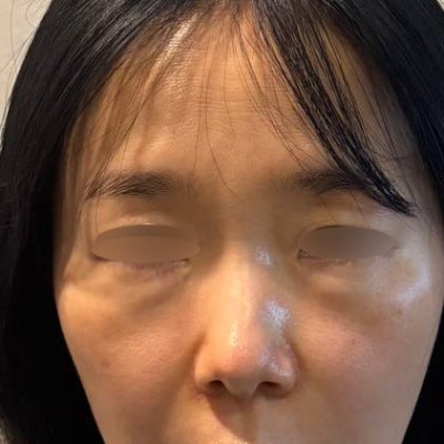 눈밑지방 + 다크서클 + 팔자주름이 함께 고민이라면? 바이브 성형외과 시그니처 '눈밑 칙프팅'으로 자연스럽게 젊어지는 방법 사진 6