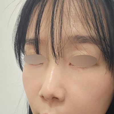눈밑지방 + 다크서클 + 팔자주름이 함께 고민이라면? 바이브 성형외과 시그니처 '눈밑 칙프팅'으로 자연스럽게 젊어지는 방법 사진 9