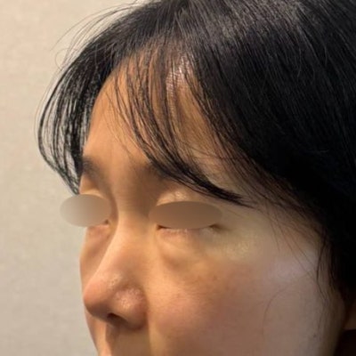 눈밑지방 + 다크서클 + 팔자주름이 함께 고민이라면? 바이브 성형외과 시그니처 '눈밑 칙프팅'으로 자연스럽게 젊어지는 방법 사진 8