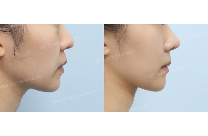 다크서클과 앞볼 꺼짐을 동시에 개선하는 바이브 성형외과 시그니처 "눈밑 칙프팅" by 신논현역 바이브 성형외과 유영문 원장 사진 5