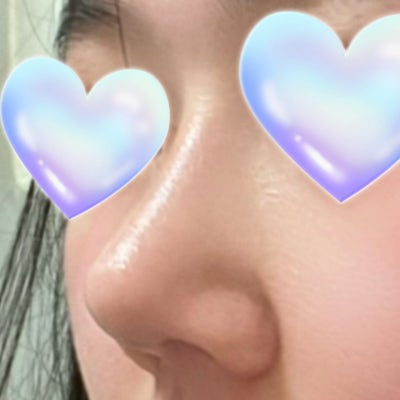 낮은 콧대·복코 고민이라면? (feat. 늑연골 코성형과 절골술) by 신논현역 바이브 성형외과 유영문 사진 8