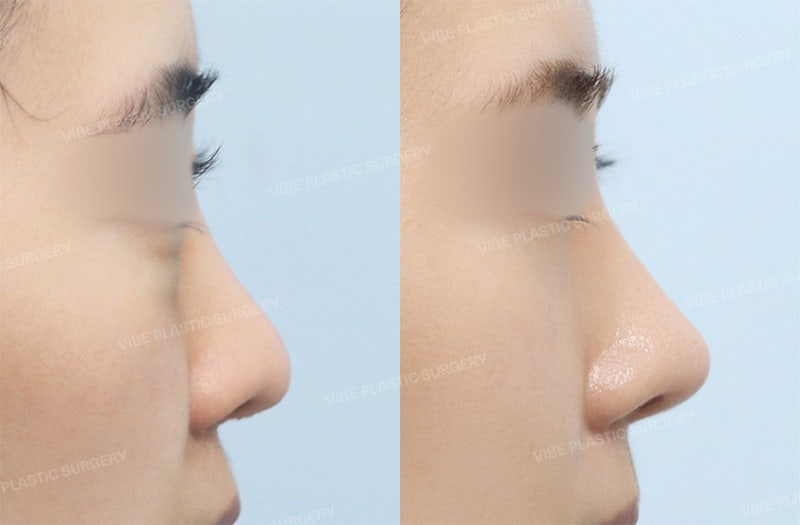 너무 좁고 인위적인 콧대가 고민이라면 "핏미 3D 맞춤 보형물"을 고려해보세요 ! by 신논현역 바이브 성형외과 유영문 원장 사진 5