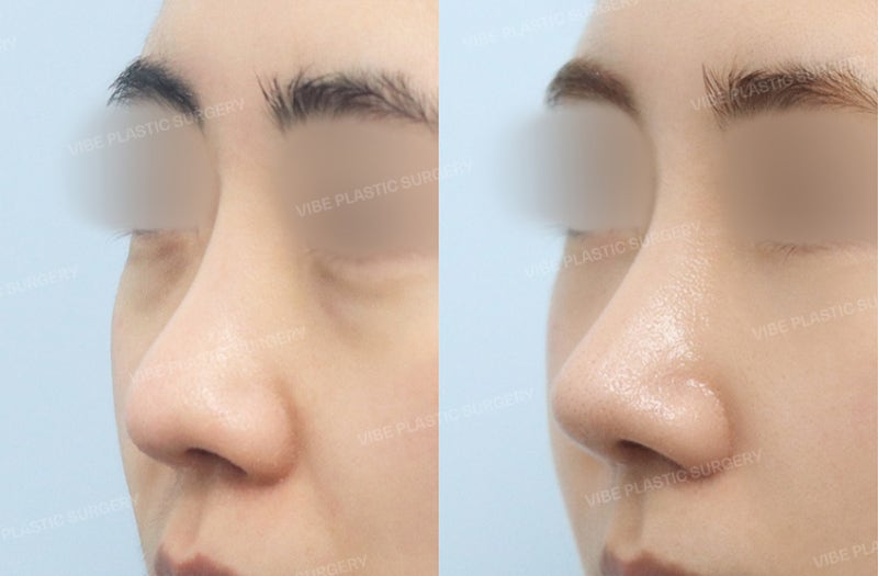 너무 좁고 인위적인 콧대가 고민이라면 "핏미 3D 맞춤 보형물"을 고려해보세요 ! by 신논현역 바이브 성형외과 유영문 원장 사진 2