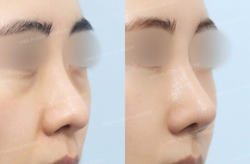 너무 좁고 인위적인 콧대가 고민이라면 "핏미 3D 맞춤 보형물"을 고려해보세요 ! by 신논현역 바이브 성형외과 유영문 원장 사진 4