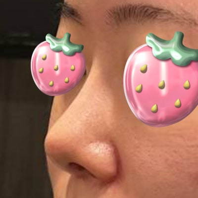 짧아진 코, 다시 길게 만들 수 있을까? (자가늑연골 코성형) by 신논현역 바이브 성형외과 유영문 원장 사진 11