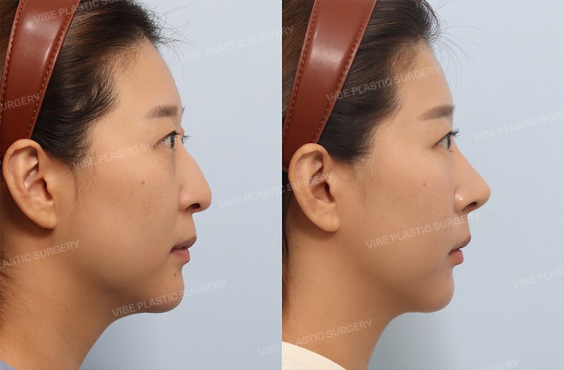 미용과 기능 ! 2마리 토끼를 함께 잡은 코 성형 케이스 by 신논현역 바이브 성형외과 유영문 원장 사진 7