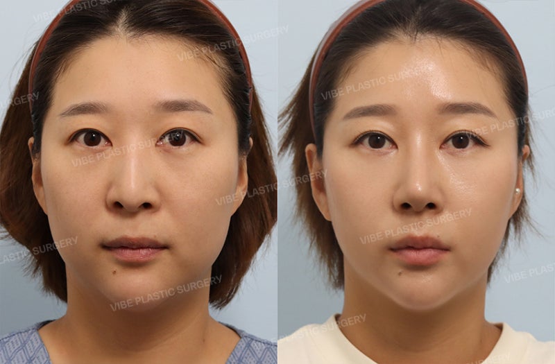 미용과 기능 ! 2마리 토끼를 함께 잡은 코 성형 케이스 by 신논현역 바이브 성형외과 유영문 원장 사진 3