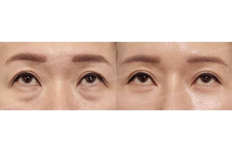 50대 눈성형, 눈썹하거상과 하안검을 함께 해야 하는 경우는? by 신논현역 바이브 성형외과 유영문 원장 사진 2