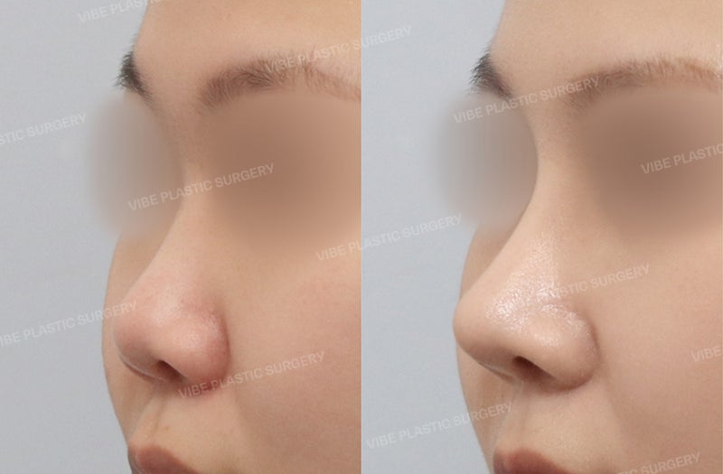 낮고 뭉뚝한 코 -> 세련되고 여성적인 직반 코라인으로 by 신논현역 바이브 성형외과 유영문 원장 사진 2