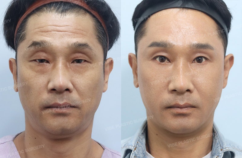 睜眼無力且特別顯老？50多歲男性眼部整形案例分享 by 新論峴站 Vibe整形外科 柳英文院長