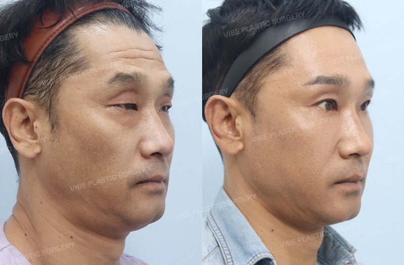 눈 뜨는 힘이 약하고 유독 나이가 들어보인다면? 50대 남자 눈성형 케이스 by 신논현역 바이브 성형외과 유영문 원장 사진 4