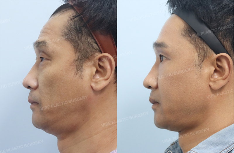 눈 뜨는 힘이 약하고 유독 나이가 들어보인다면? 50대 남자 눈성형 케이스 by 신논현역 바이브 성형외과 유영문 원장 사진 3