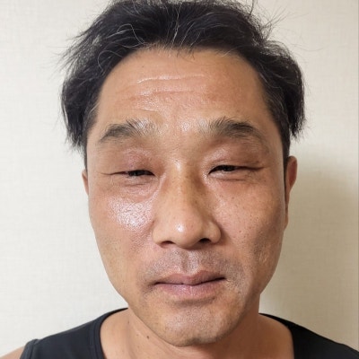 눈 뜨는 힘이 약하고 유독 나이가 들어보인다면? 50대 남자 눈성형 케이스 by 신논현역 바이브 성형외과 유영문 원장 사진 6