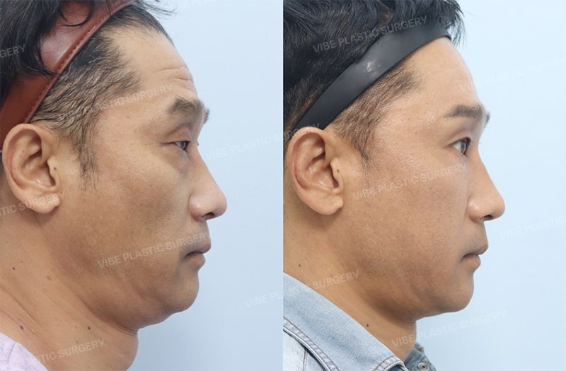 눈 뜨는 힘이 약하고 유독 나이가 들어보인다면? 50대 남자 눈성형 케이스 by 신논현역 바이브 성형외과 유영문 원장 사진 5