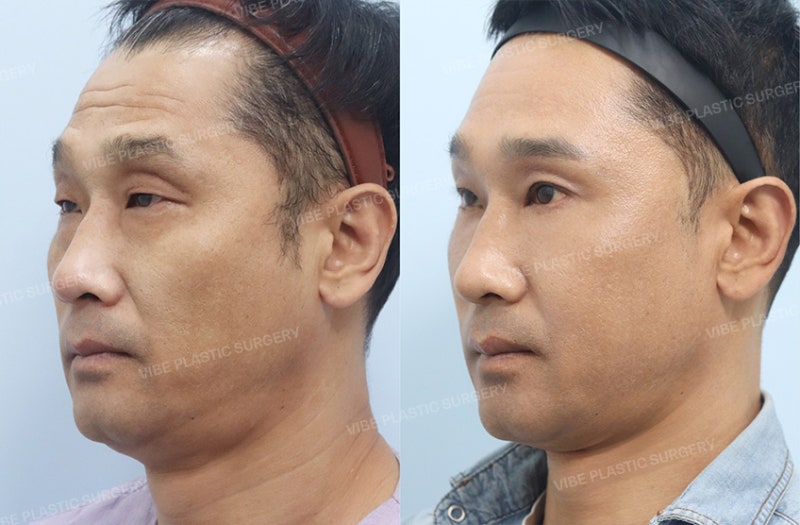 눈 뜨는 힘이 약하고 유독 나이가 들어보인다면? 50대 남자 눈성형 케이스 by 신논현역 바이브 성형외과 유영문 원장 사진 2