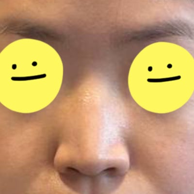 실리콘 없이 비중격과 귀연골만으로도 코 성형이 가능할까? by 신논현역 바이브 성형외과 유영문 원장 사진 7