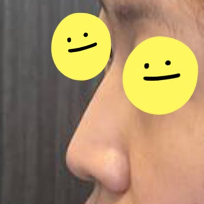실리콘 없이 비중격과 귀연골만으로도 코 성형이 가능할까? by 신논현역 바이브 성형외과 유영문 원장 사진 9