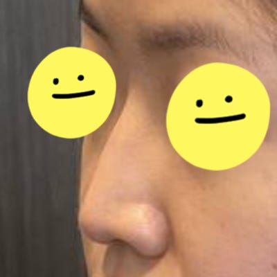 실리콘 없이 비중격과 귀연골만으로도 코 성형이 가능할까? by 신논현역 바이브 성형외과 유영문 원장 사진 11