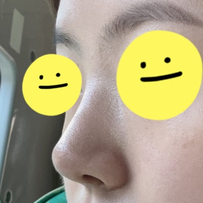 실리콘 없이 비중격과 귀연골만으로도 코 성형이 가능할까? by 신논현역 바이브 성형외과 유영문 원장 사진 12