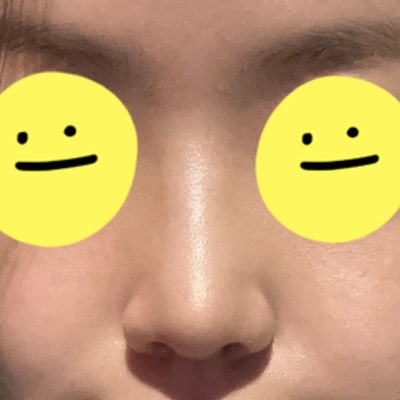 실리콘 없이 비중격과 귀연골만으로도 코 성형이 가능할까? by 신논현역 바이브 성형외과 유영문 원장 사진 8