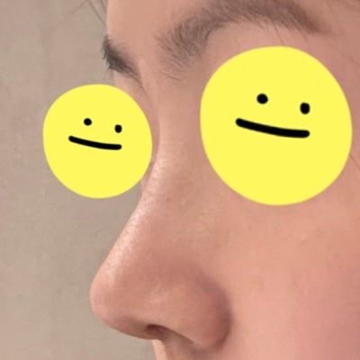 실리콘 없이 비중격과 귀연골만으로도 코 성형이 가능할까? by 신논현역 바이브 성형외과 유영문 원장 사진 10