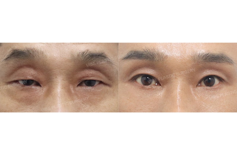 熟男眼部整形：戲劇性且自然的轉變 by 新論峴站 VIBE 整形外科 柳英文院長