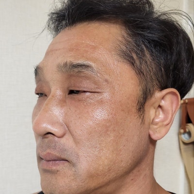 熟男眼部整形:戲劇性且自然的轉變 by 新論峴站 VIBE 整形外科 柳英文院長 사진 5