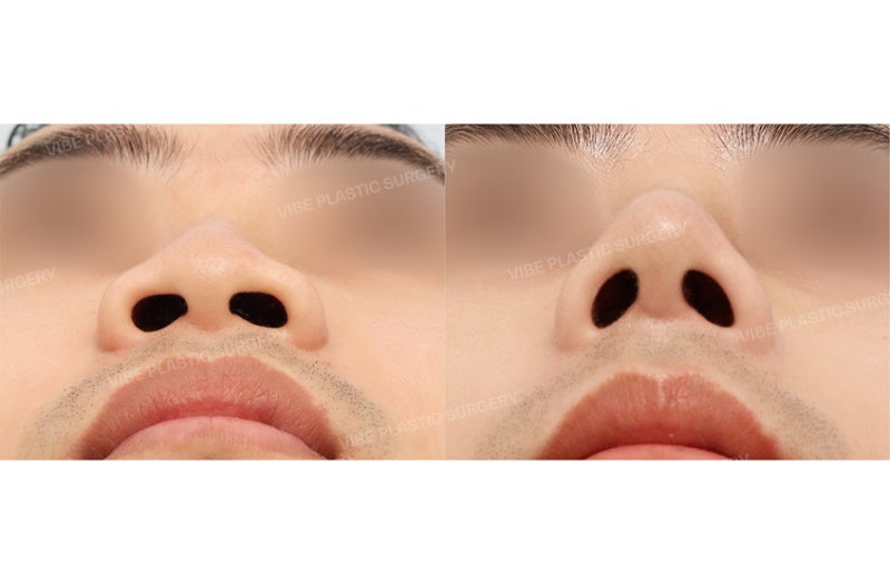 남자 코성형, 코만 멋있게 만드는 수술일까요?｜비중격 만곡증까지 교정한 기능코성형 by 신논현역 바이브 성형외과 유영문 원장 사진 6