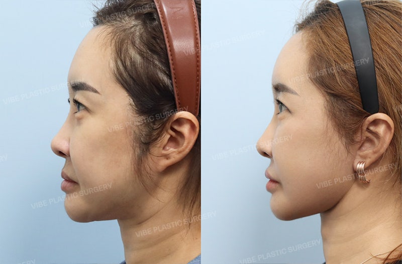 Facelift in Your 40s: Is It Really Too Early? | When Mini Facelifts and Thread Lifts Fall Short, by VIBE Plastic Surgery