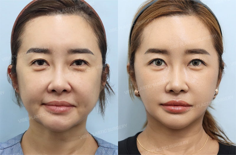 40歲做臉部拉皮，您還覺得太早嗎？｜迷你拉皮、埋線拉提後仍不滿意時的選擇 by 新論峴站 VIBE整形外科