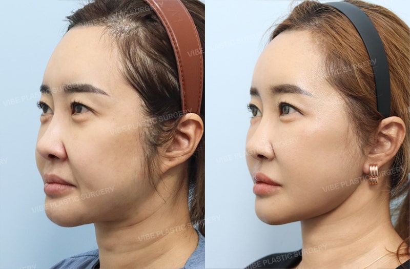 Facelift in Your 40s: Is It Really Too Early? | When Mini Facelifts and Thread Lifts Fall Short, by VIBE Plastic Surgery