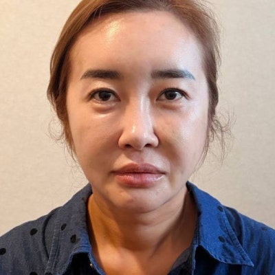 Facelift in Your 40s: Is It Really Too Early? | When Mini Facelifts and Thread Lifts Fall Short, by VIBE Plastic Surgery